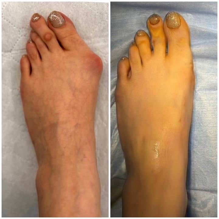 پای بیمار با برآمدگی بونیون قبل از جراحی، کنار همان پا با شست صافشده بعد از جراحی